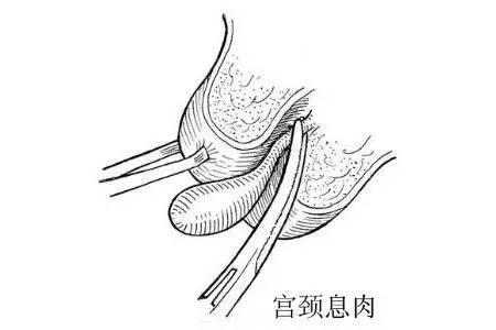 宫颈息肉
