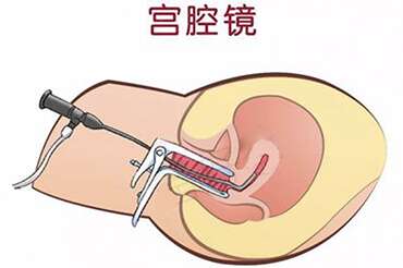 宫腔镜检查