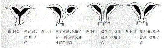 双子宫