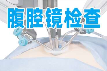 腹腔镜检查