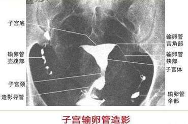 子宫输卵管造影