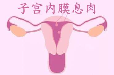 子宫内膜息肉