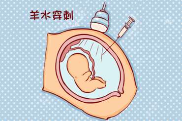 羊水穿刺
