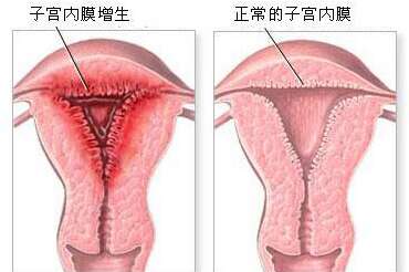 子宫内膜增厚