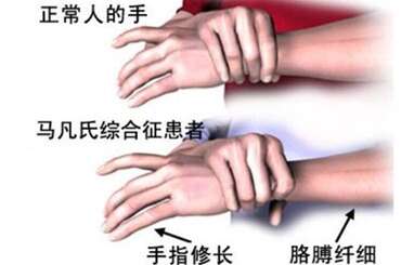 马方综合征