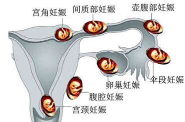 腹腔妊娠