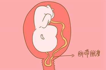 脐带脱垂