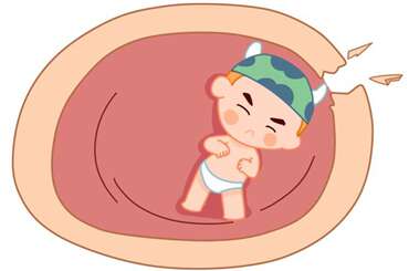 胎膜早破