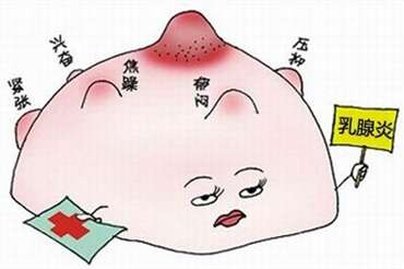 哺乳期乳腺炎