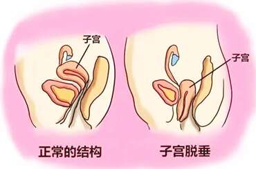 子宫脱垂