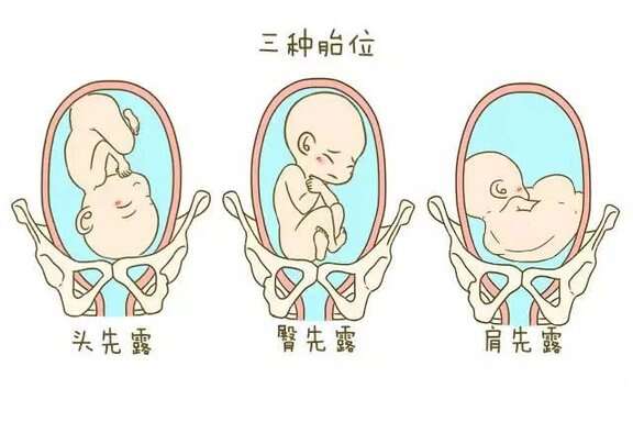 该怎么样纠正广州助孕胎儿胎位不正