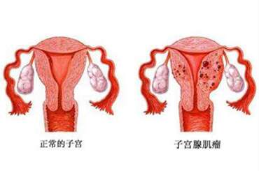 多囊卵巢综合症为何难怀孕
