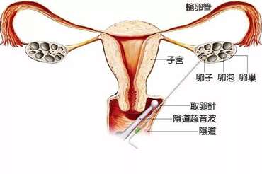 赴美取卵常见问题