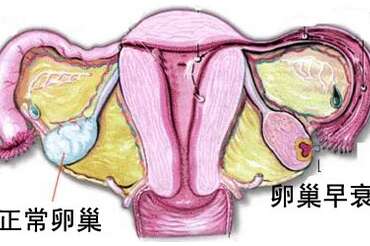 如何调理卵巢早衰