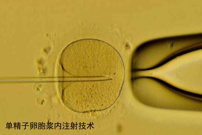 单精子卵胞浆内注射技术