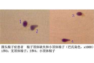 圆头精子症无法启动胚胎发育，该怎么办？