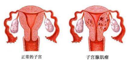 3个症状看你的子宫健不健康